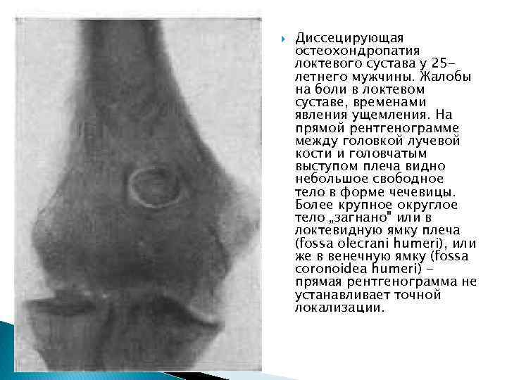  Диссецирующая остеохондропатия локтевого сустава у 25 летнего мужчины. Жалобы на боли в локтевом