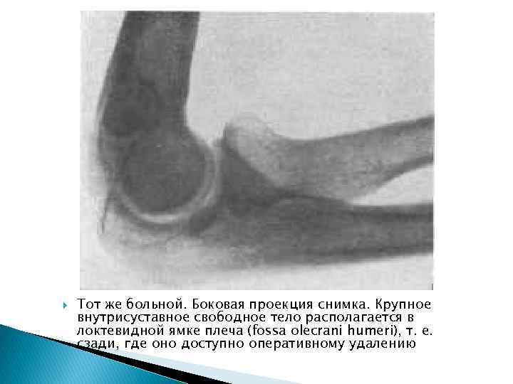  Тот же больной. Боковая проекция снимка. Крупное внутрисуставное свободное тело располагается в локтевидной