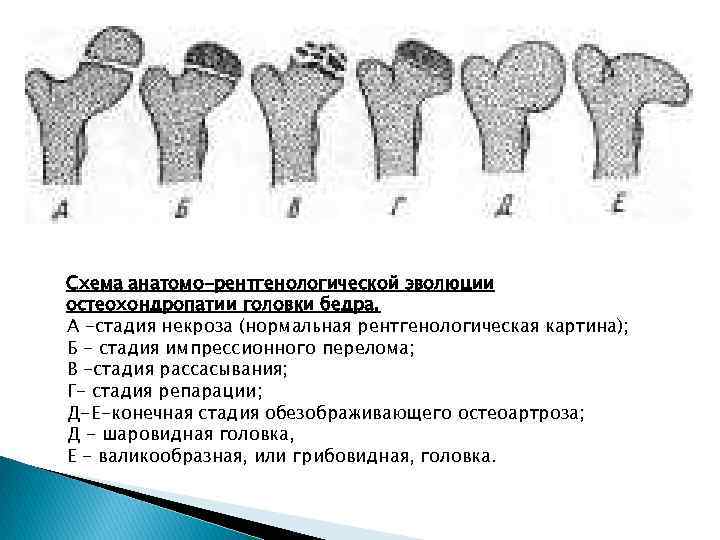 Для разгара рахита характерна следующая рентгенологическая картина