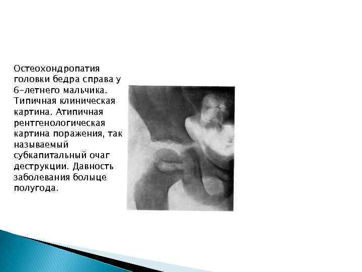 Остеохондропатия головки бедра справа у 6 -летнего мальчика. Типичная клиническая картина. Атипичная рентгенологическая картина