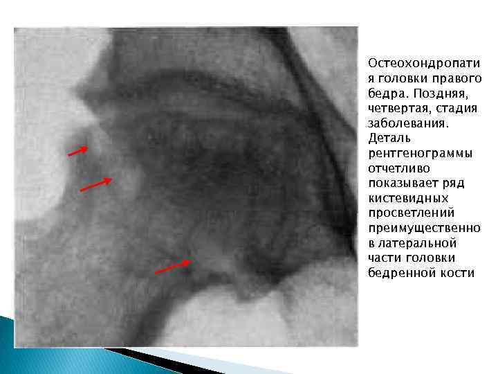Остеохондропати я головки правого бедра. Поздняя, четвертая, стадия заболевания. Деталь рентгенограммы отчетливо показывает ряд