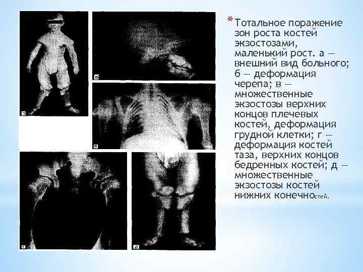 * Тотальное поражение зон роста костей экзостозами, маленький рост. а — внешний вид больного;