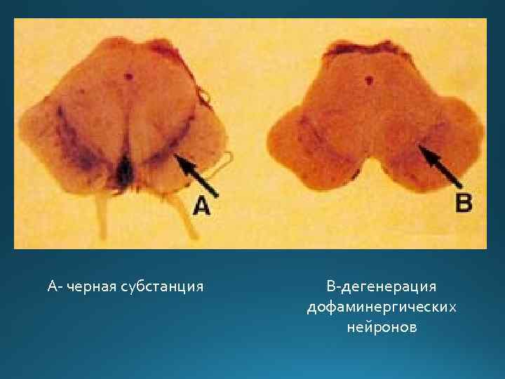 А- черная субстанция В-дегенерация дофаминергических нейронов 