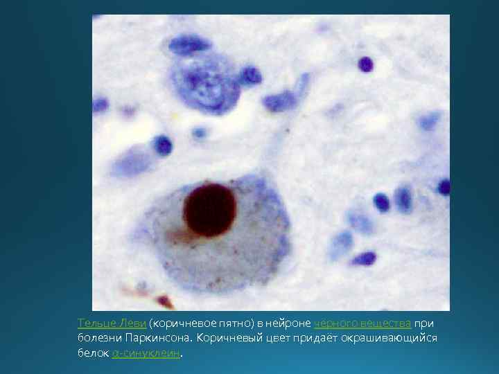 Тельце Леви (коричневое пятно) в нейроне чёрного вещества при болезни Паркинсона. Коричневый цвет придаёт