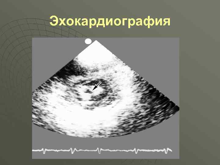 Эхокардиография 