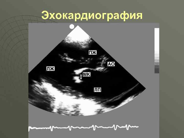 Эхокардиография 