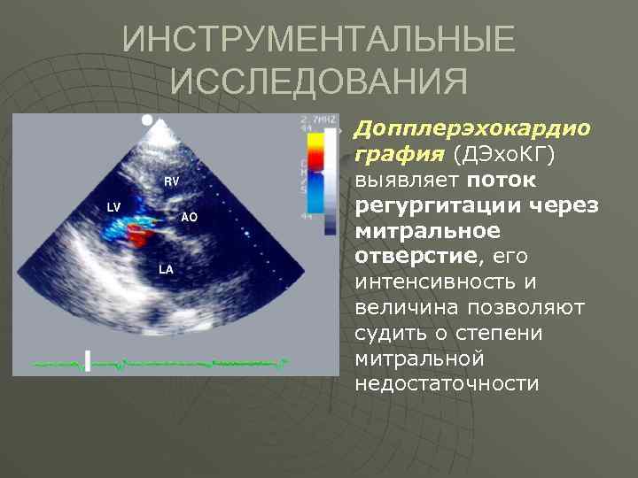 ИНСТРУМЕНТАЛЬНЫЕ ИССЛЕДОВАНИЯ u Допплерэхокардио графия (ДЭхо. КГ) выявляет поток регургитации через митральное отверстие, его