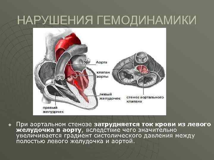 Стеноз артериального клапана сердца