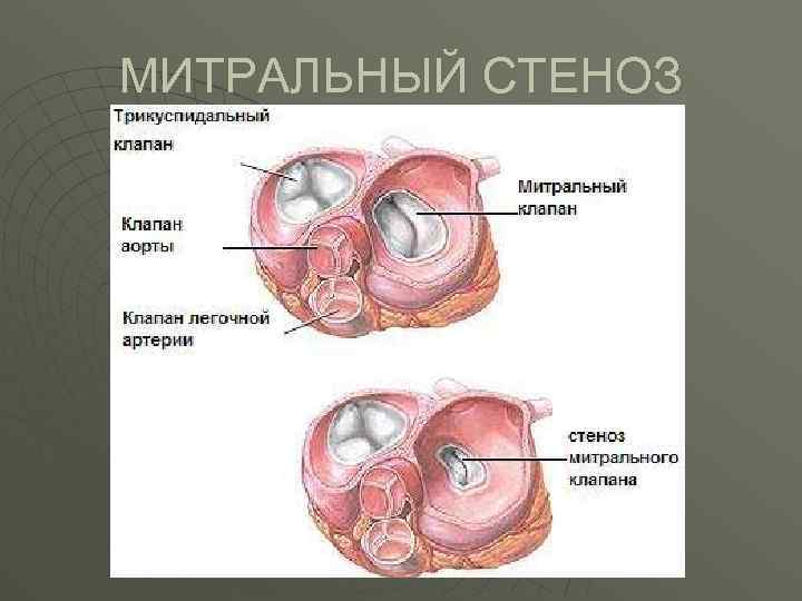 МИТРАЛЬНЫЙ СТЕНОЗ 