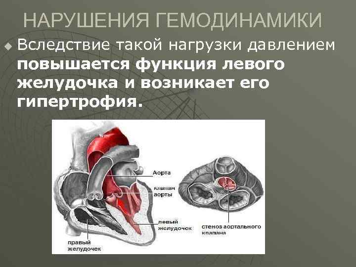 Аускультативная картина при митральном стенозе сердца включает