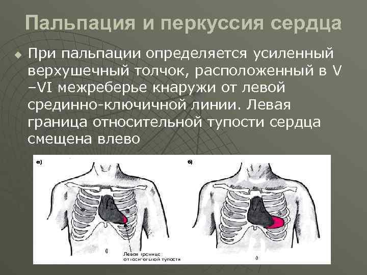 Пальпация сердца. Верхушечный толчок в 5 межреберье. Левожелудочковый толчок в 6 межреберье. Пальпация и перкуссия при пороке сердца. Перкуссия 5 межреберье.