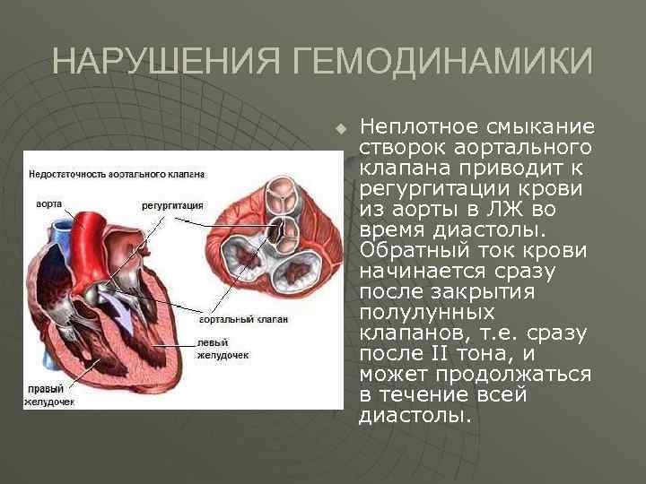 Расхождение створок аортального клапана