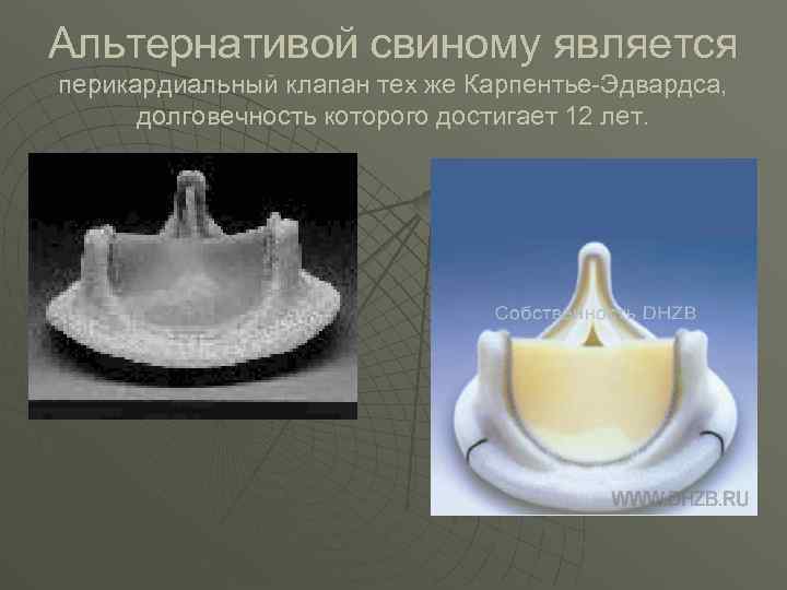 Альтернативой свиному является перикардиальный клапан тех же Карпентье-Эдвардса, долговечность которого достигает 12 лет. 