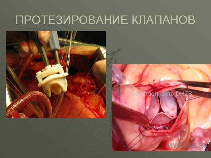 ПРОТЕЗИРОВАНИЕ КЛАПАНОВ 