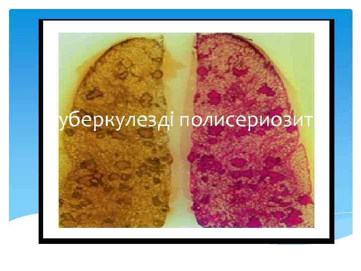 Туберкулезді полисериозит 