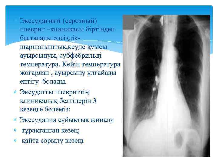  Экссудативті (серозный) плеврит –клиникасы біртіндеп басталады әлсіздікшаршағыштық, кеуде қуысы ауырсынуы, субфебрильді температура. Кейін