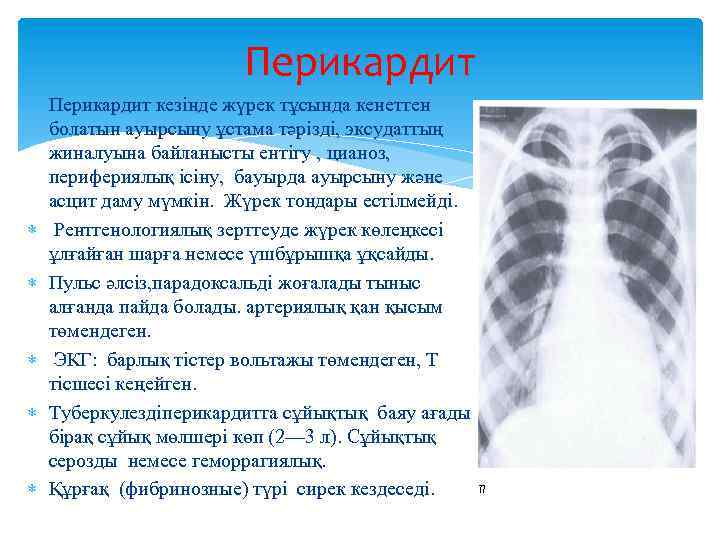 Перикардит кезінде жүрек тұсында кенеттен болатын ауырсыну ұстама тәрізді, эксудаттың жиналуына байланысты ентігу ,