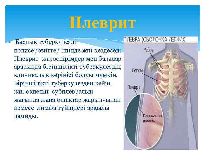 Плеврит легких что это