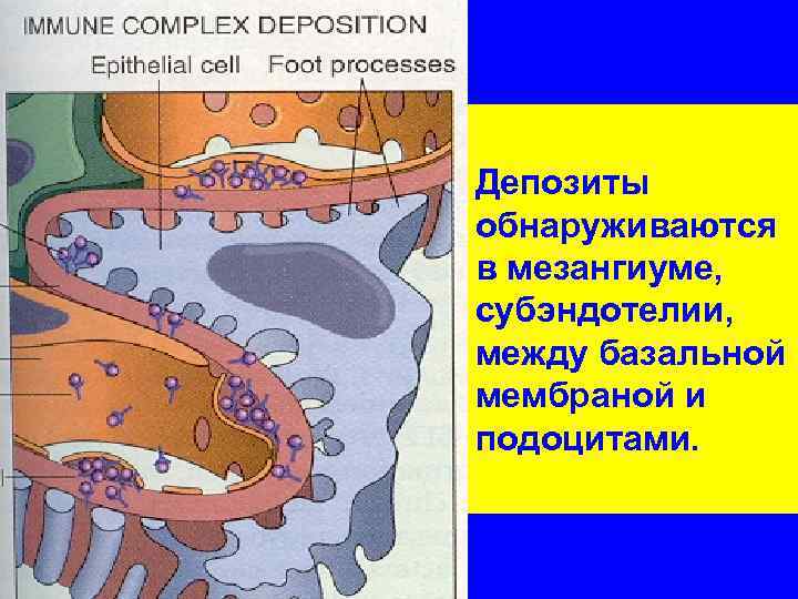 Депозиты обнаруживаются в мезангиуме, субэндотелии, между базальной мембраной и подоцитами. 