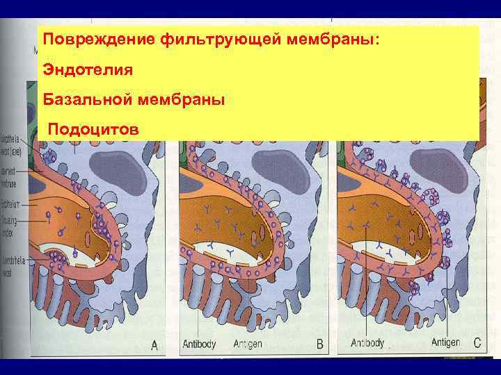 Повреждение фильтрующей мембраны: Эндотелия Базальной мембраны Подоцитов 