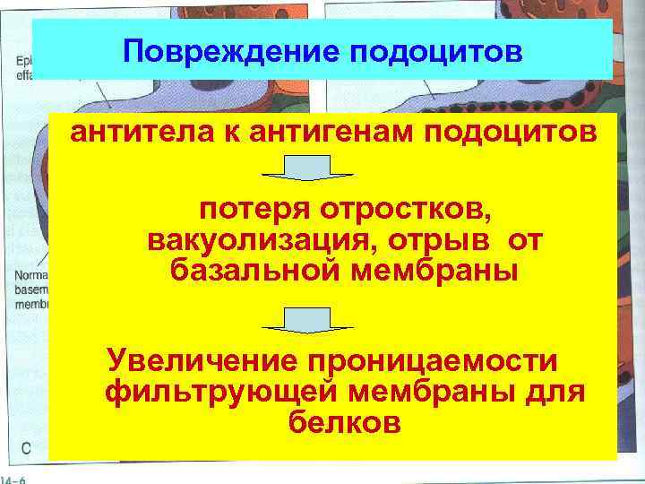 Повреждение подоцитов антитела к антигенам подоцитов потеря отростков, вакуолизация, отрыв от базальной мембраны Увеличение