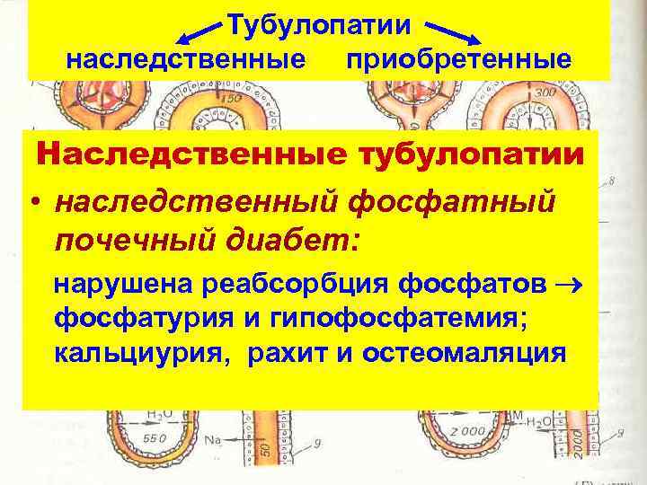 Тубулопатии наследственные приобретенные Наследственные тубулопатии • наследственный фосфатный почечный диабет: нарушена реабсорбция фосфатов фосфатурия