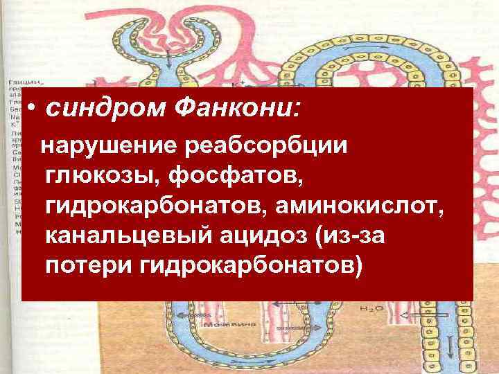  • синдром Фанкони: нарушение реабсорбции глюкозы, фосфатов, гидрокарбонатов, аминокислот, канальцевый ацидоз (из-за потери