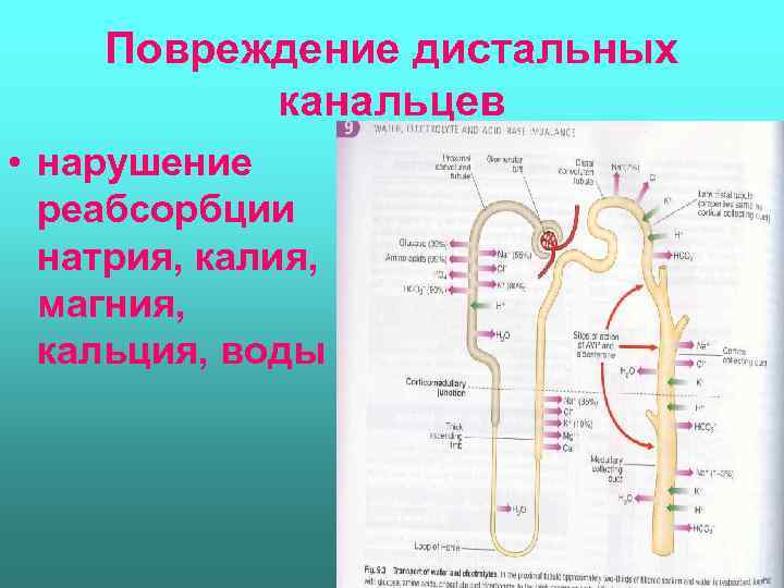 Повреждение дистальных канальцев • нарушение реабсорбции натрия, калия, магния, кальция, воды 