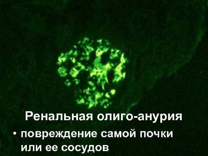 Ренальная олиго-анурия • повреждение самой почки или ее сосудов 