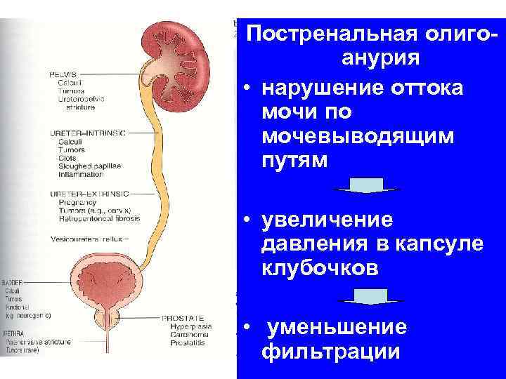 Постренальная олигоанурия • нарушение оттока мочи по мочевыводящим путям • увеличение давления в капсуле