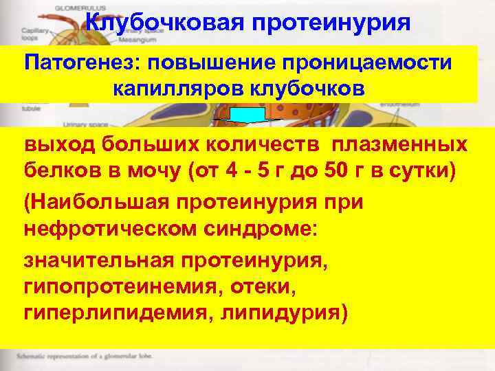 Клубочковая протеинурия Патогенез: повышение проницаемости капилляров клубочков выход больших количеств плазменных белков в мочу
