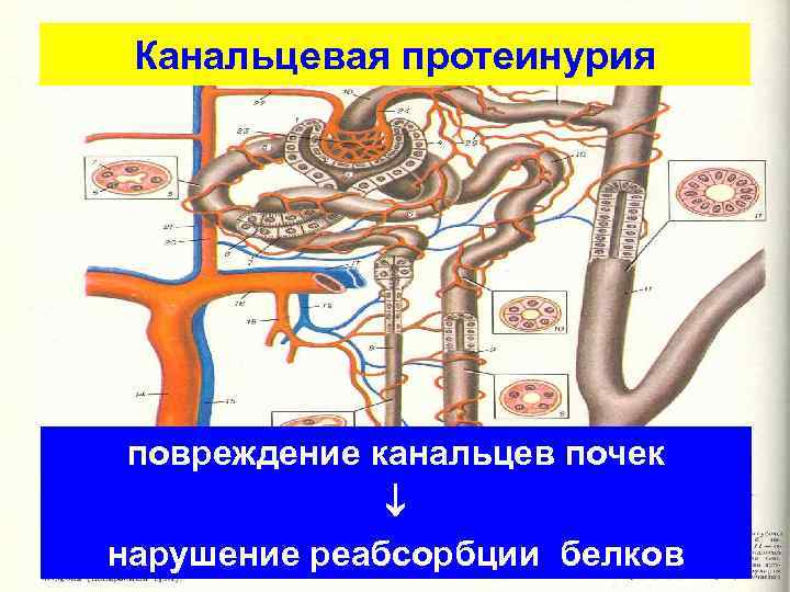Канальцевая протеинурия повреждение канальцев почек нарушение реабсорбции белков 
