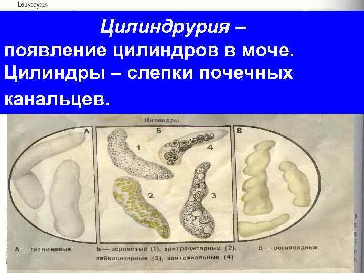 Цилиндрурия – появление цилиндров в моче. Цилиндры – слепки почечных канальцев. 
