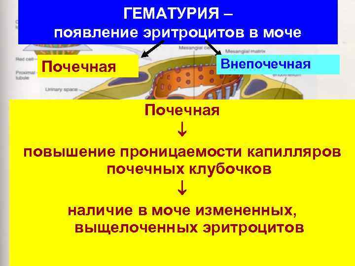 ГЕМАТУРИЯ – появление эритроцитов в моче Почечная Внепочечная Почечная повышение проницаемости капилляров почечных клубочков
