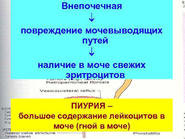 Внепочечная повреждение мочевыводящих путей наличие в моче свежих эритроцитов ПИУРИЯ – большое содержание лейкоцитов