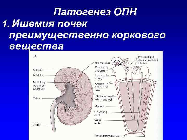 Патогенез ОПН 1. Ишемия почек преимущественно коркового вещества 