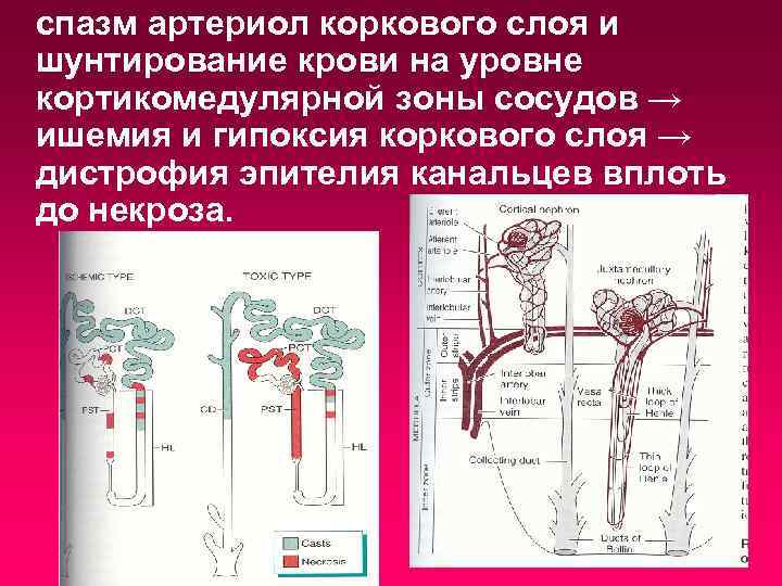 спазм артериол коркового слоя и шунтирование крови на уровне кортикомедулярной зоны сосудов → ишемия
