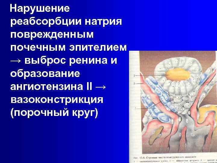 Нарушение реабсорбции натрия поврежденным почечным эпителием → выброс ренина и образование ангиотензина II →