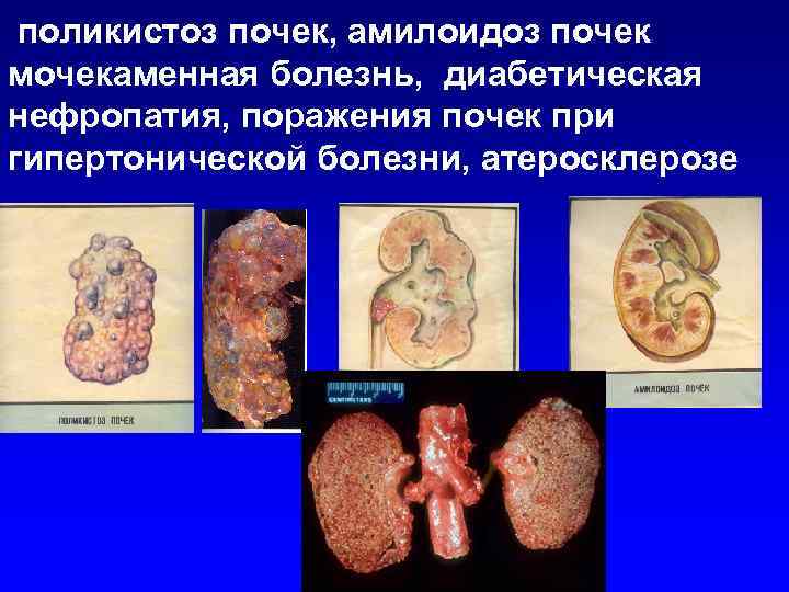 поликистоз почек, амилоидоз почек мочекаменная болезнь, диабетическая нефропатия, поражения почек при гипертонической болезни, атеросклерозе