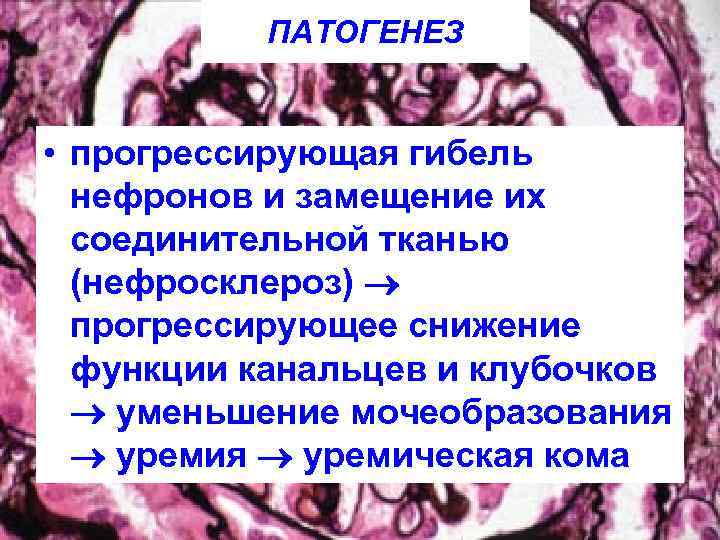 ПАТОГЕНЕЗ • прогрессирующая гибель нефронов и замещение их соединительной тканью (нефросклероз) прогрессирующее снижение функции