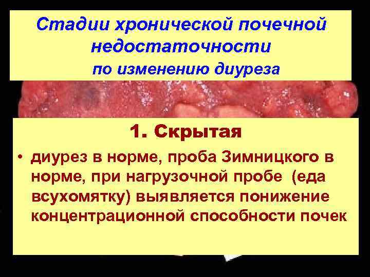 Стадии хронической почечной недостаточности по изменению диуреза 1. Скрытая • диурез в норме, проба