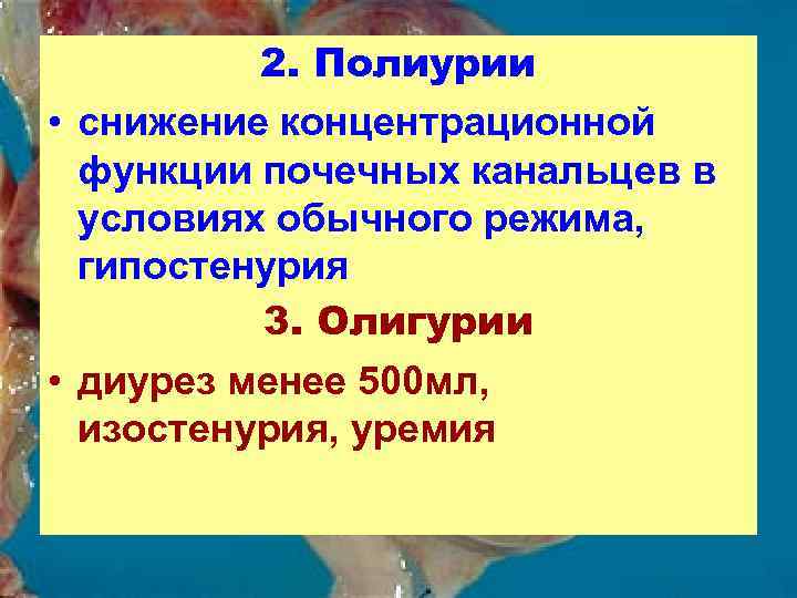2. Полиурии • снижение концентрационной функции почечных канальцев в условиях обычного режима, гипостенурия 3.