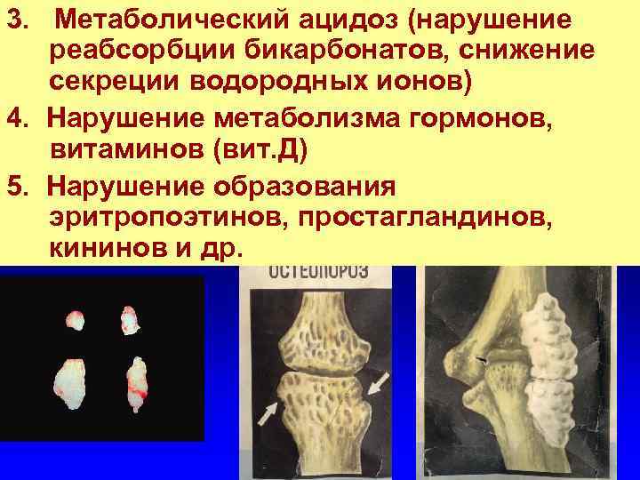 3. Метаболический ацидоз (нарушение реабсорбции бикарбонатов, снижение секреции водородных ионов) 4. Нарушение метаболизма гормонов,