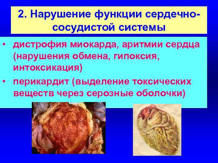 2. Нарушение функции сердечнососудистой системы • дистрофия миокарда, аритмии сердца (нарушения обмена, гипоксия, интоксикация)