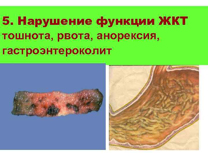 5. Нарушение функции ЖКТ тошнота, рвота, анорексия, гастроэнтероколит 