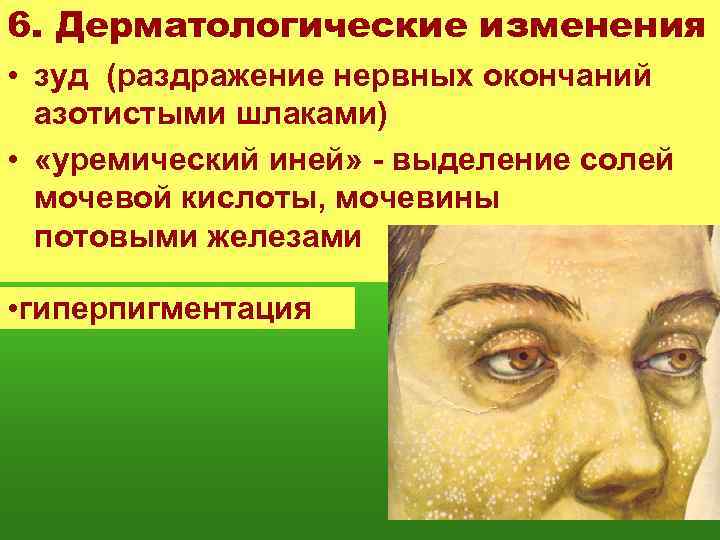 6. Дерматологические изменения • зуд (раздражение нервных окончаний азотистыми шлаками) • «уремический иней» -