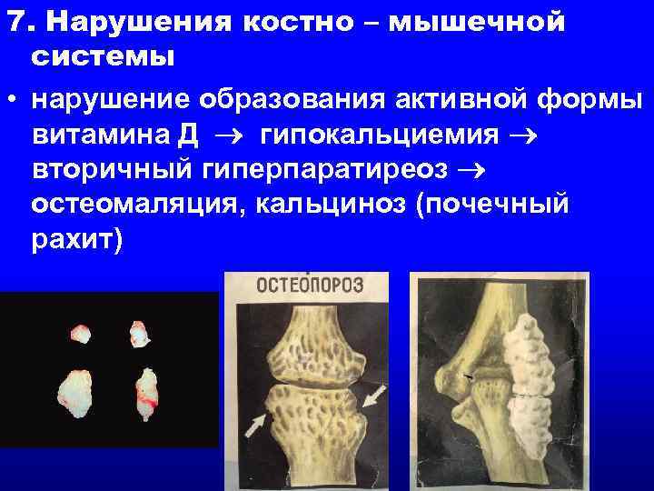 7. Нарушения костно – мышечной системы • нарушение образования активной формы витамина Д гипокальциемия