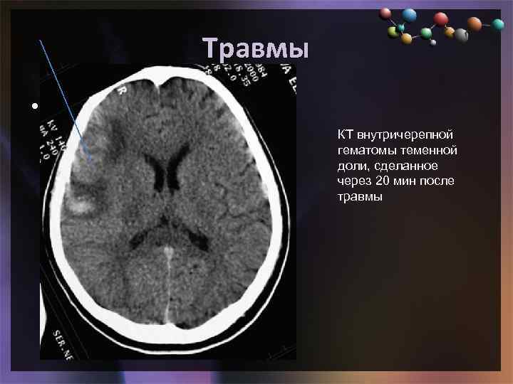 Травмы • Подзаголовок слайда КТ внутричерепной гематомы теменной доли, сделанное через 20 мин после