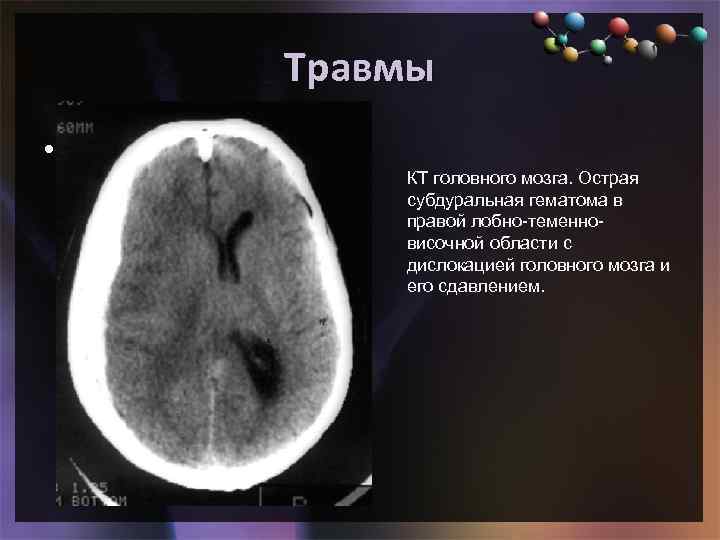 Травмы • Подзаголовок слайда КТ головного мозга. Острая субдуральная гематома в правой лобно-теменновисочной области