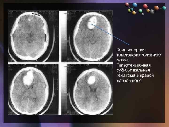  • Подзаголовок слайда Компьютерная томография головного мозга. Гипертензионная субкортикальная гематома в правой лобной
